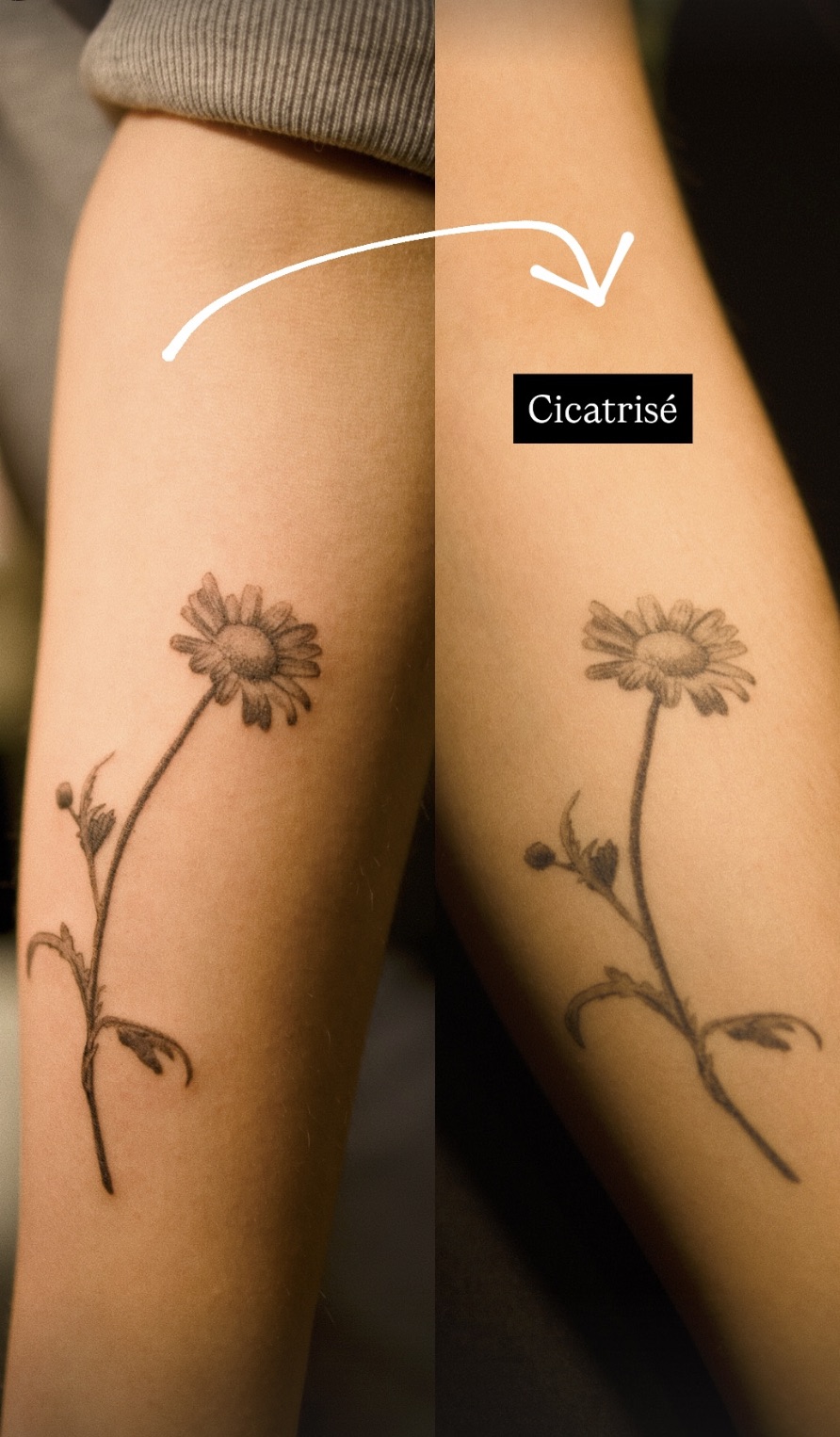 Tatouage fleur en micro-réalisme, avant et après cicatrisation, Couleur Gris Bordeaux